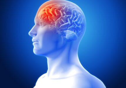 L&rsquo;accident vasculaire cérébral