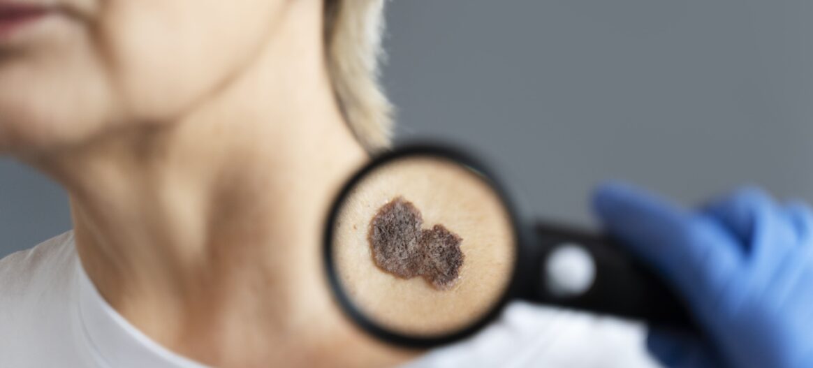 Sensibilisation au cancer de la peau